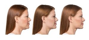 Kybella diminishes double chins