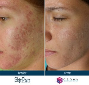 SkinPen Microneedling