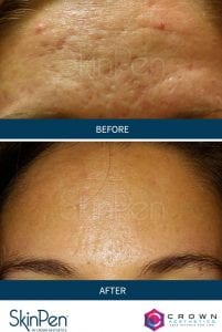 SkinPen Microneedling Forehead