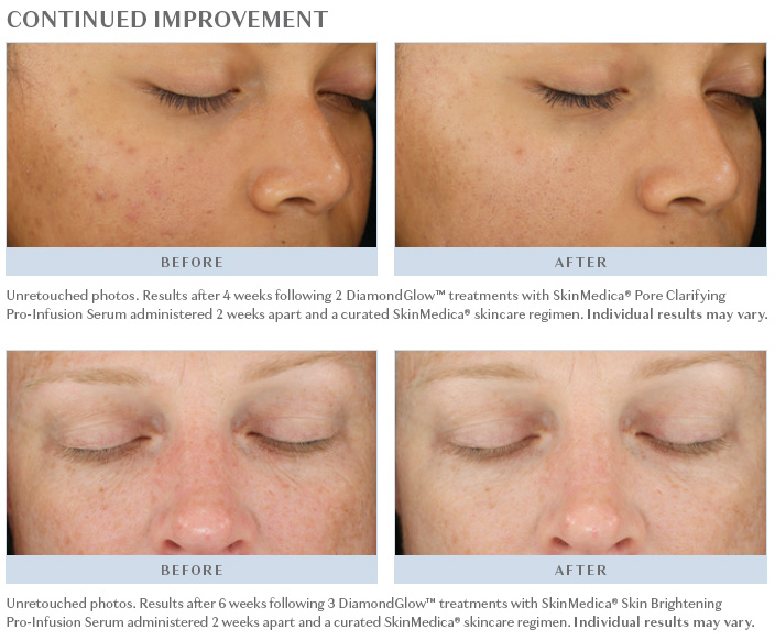 continued-improvement-slim DiamondGlow Continued Improvement