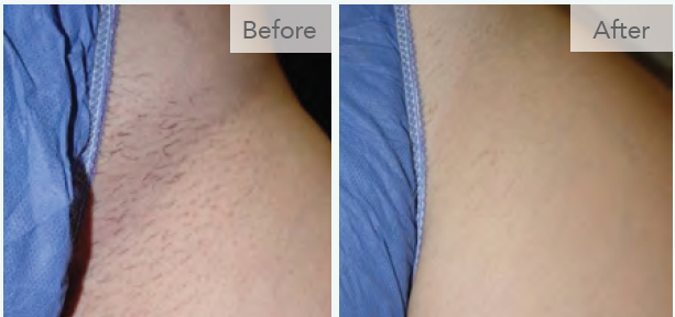 Bikini Laser Hair Removal