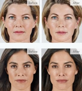 Juvederm Collection of Fillers at Revive Medical Spa
