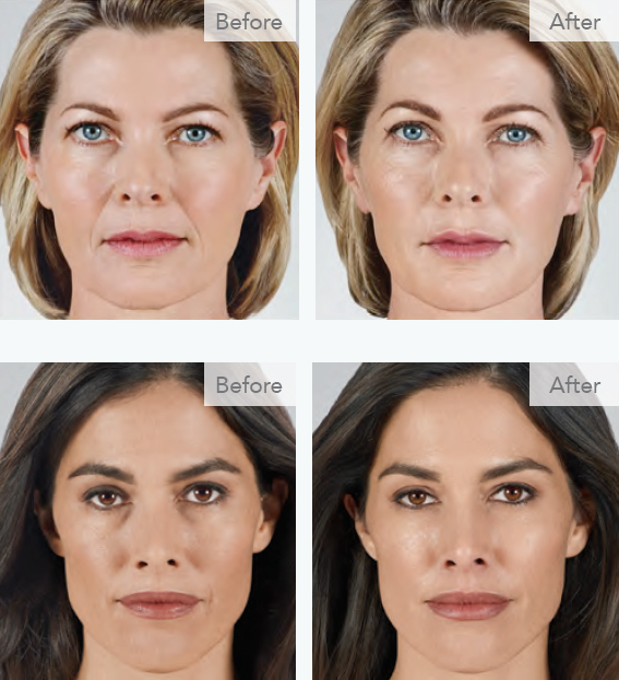 6 Simple Techniques For How Long Does Juvéderm Last? - Fullerton, Ca - Full ...What Does How Long Does Juvederm Last And What To Expect With The ... Do? thumbnail