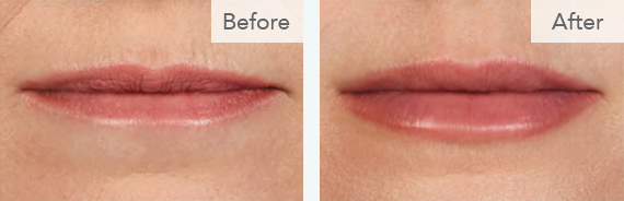 Juvederm Lips at Revive Medical Spa