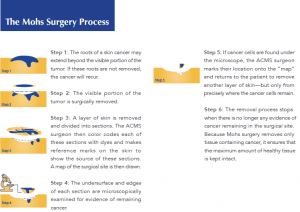 Mohs surgery process