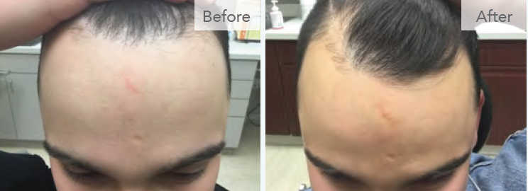 Hair loss - PRP Hair Restoration at Revive Medical Spa