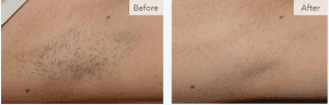 Underarm Laser Hair Removal
