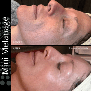 Mini Melanage Peel Before and After