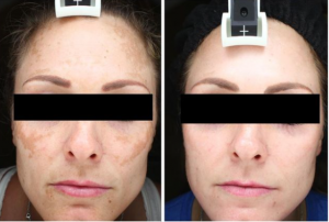 Melanage Peel Before and After