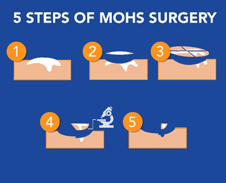 Mohs Surgery - the Gold Standard for Skin Cancer Removal