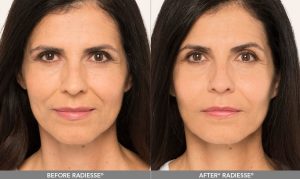 Radiesse - Before and after, female, age 52