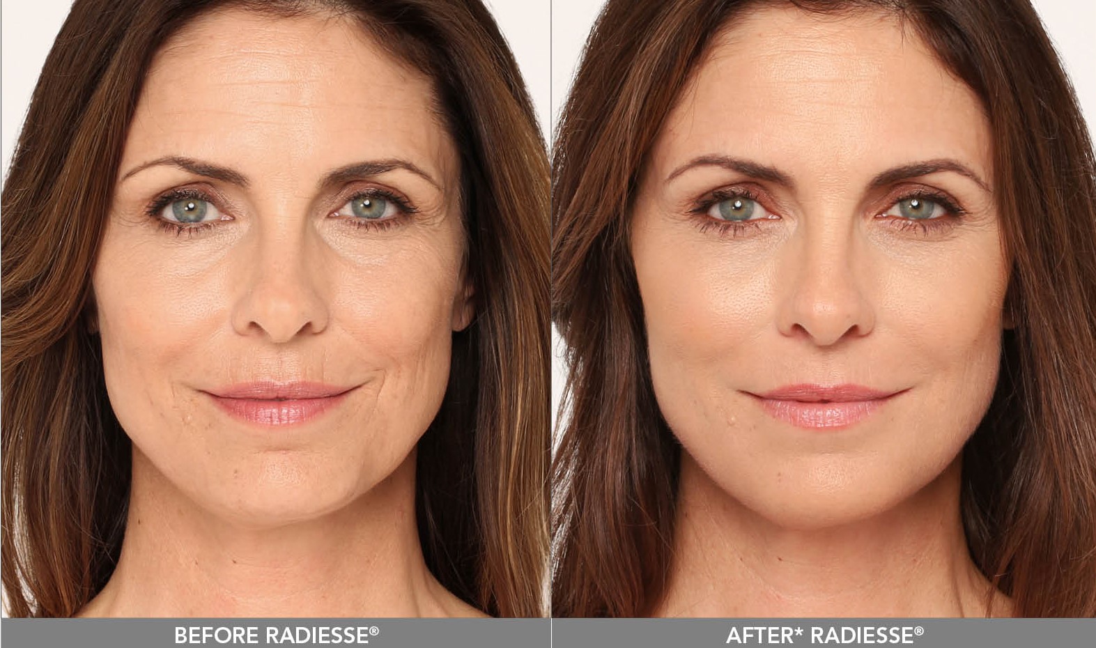 Radiesse Advanced Dermatology Revive Medical Spa, LLC