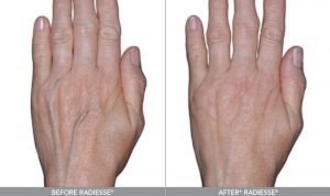 Radiesse Hands, Female, Age 59