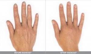 Radiesse Hands, Female, Age 44, Before and After