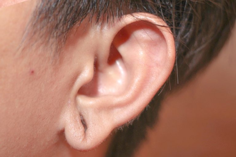 Earlobe Repair Advanced Dermatology