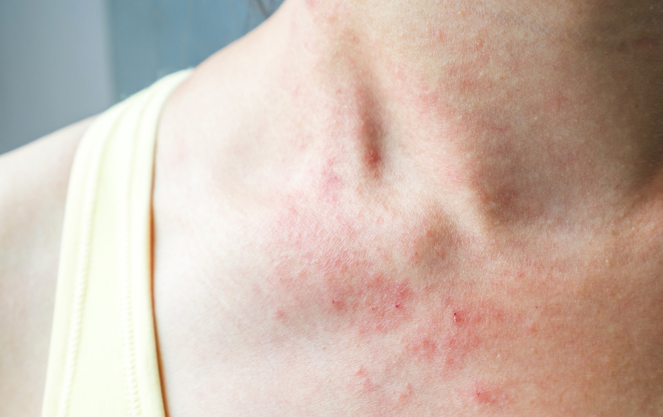 Dry winter skin can appear red and cracked and be very uncomfortable.