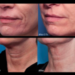 Genius RF Microneedling to Rejuvenate Skin at Revive