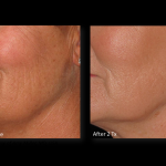 Genius RF Microneedling to Rejuvenate Skin at Revive