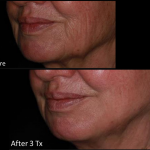 Genius RF Microneedling to Rejuvenate Skin at Revive