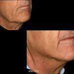 Genius RF Microneedling to Rejuvenate Skin at Revive