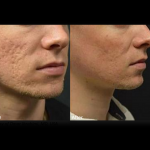 Genius RF Microneedling to Rejuvenate Skin at Revive