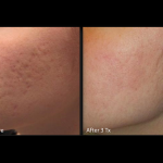 Genius RF Microneedling to Rejuvenate Skin at Revive