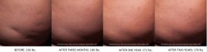 Cellfina at Revive - Before and After, Eliminates Cellulite