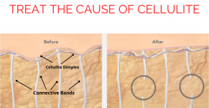 Treat the cause of cellulite with Cellfina
