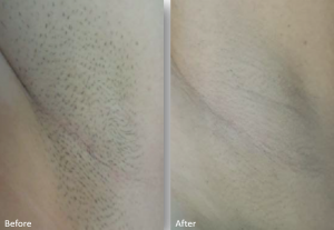 Underarm laser hair removal