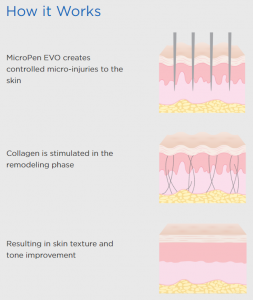 Microneedling explained