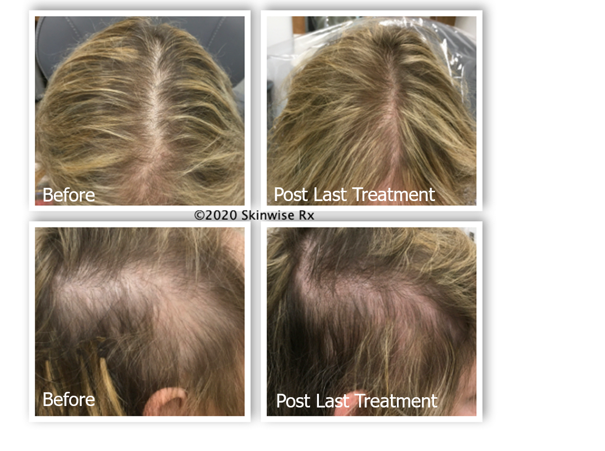 KeraLase hair Restoration