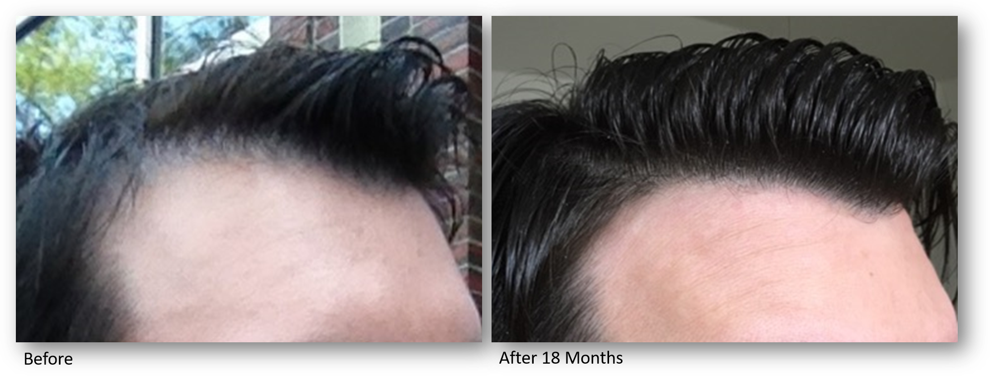 KeraLase hair Restoration