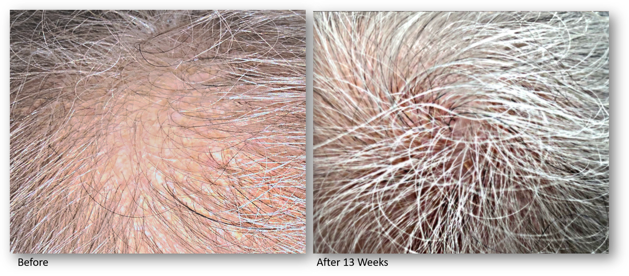 KeraLase hair Restoration