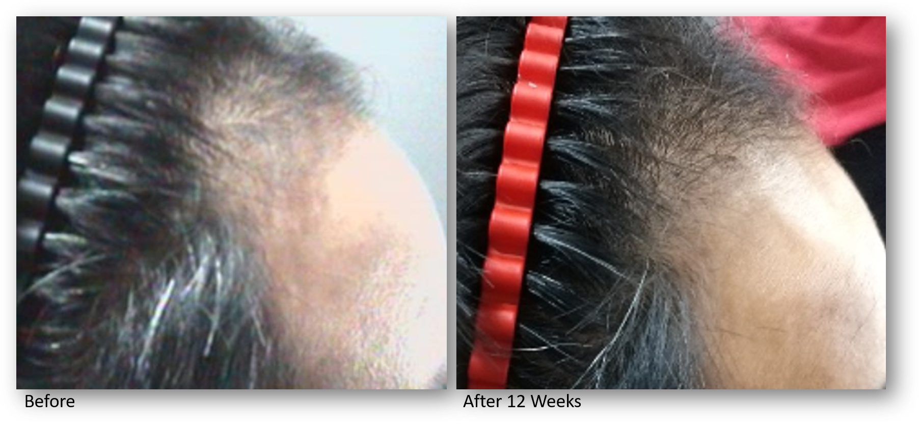 KeraLase hair Restoration