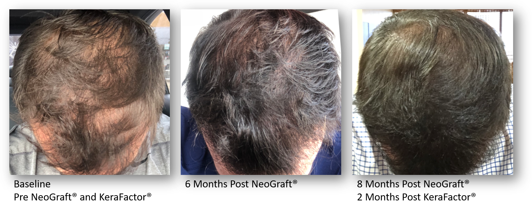 KeraLase hair Restoration