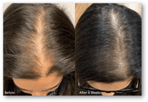 KeraLase Hair Restoration