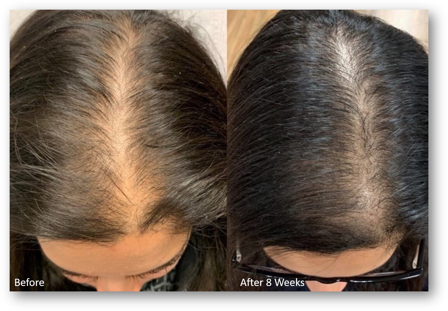 KeraLase Hair Restoration