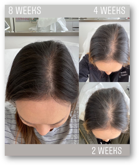 KeraLase hair Restoration