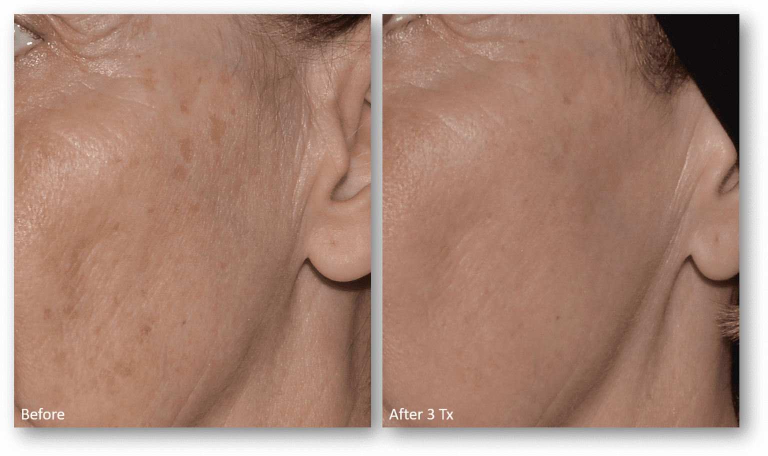 Ultra Laser at Revive Medical Spa, LLC - AdvancedSkinMD.com