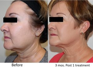 Ultra RF Before and After Facial Rejuvenation