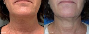 Ultra RF before and after neck and face rejuvenation