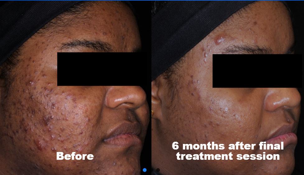 AviClear Acne Treatment, before and after