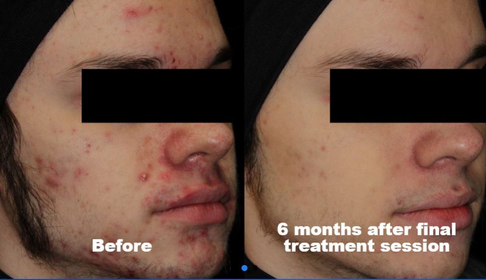 AviClear Acne Treatment, before and after