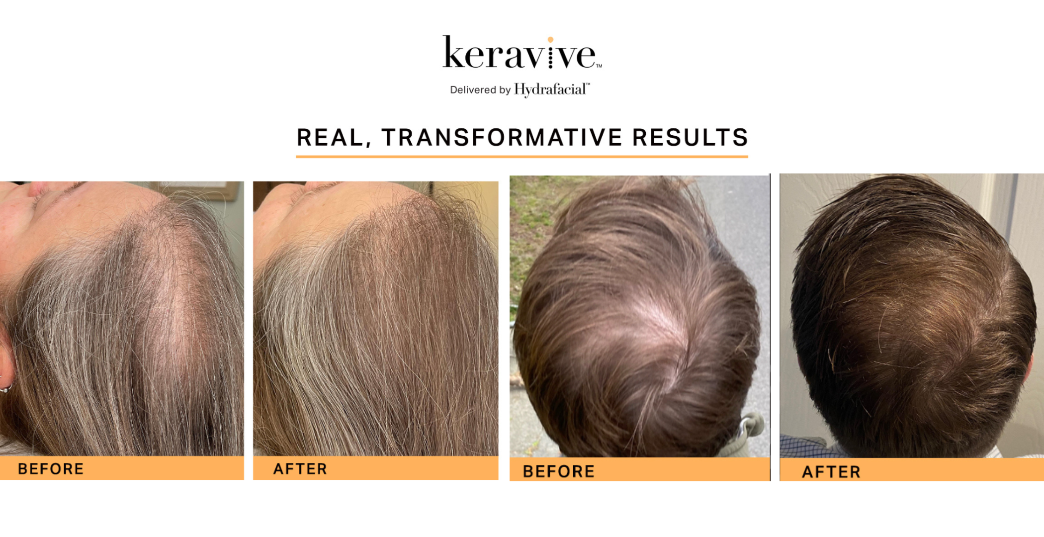 Keravive by Hydrafacial Fayetteville Rogers Harrison Keravive by Hydrafacial Fayetteville Rogers Harrison