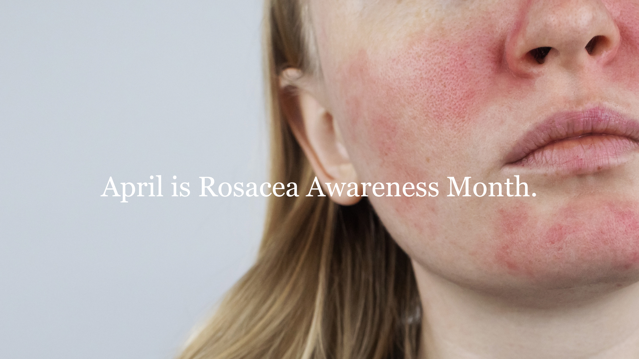 Rosacea skincare