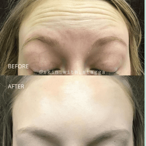 Injectable Before and After - Revive Medical Spa