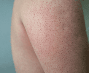Keratosis Pilaris or KP