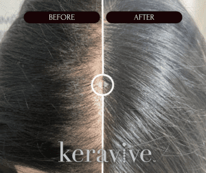 Keravive Hair Thinning Treatment before and after