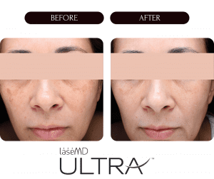 Laser treatments Laser Treatment Ultra