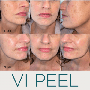 pigmentation and sun damage treatments chemical peel vi peel